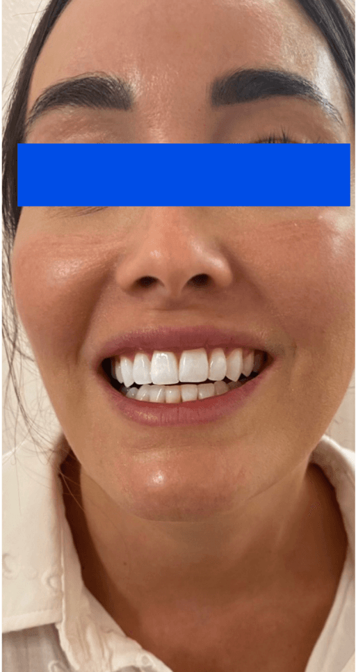 Sourire après le traitement